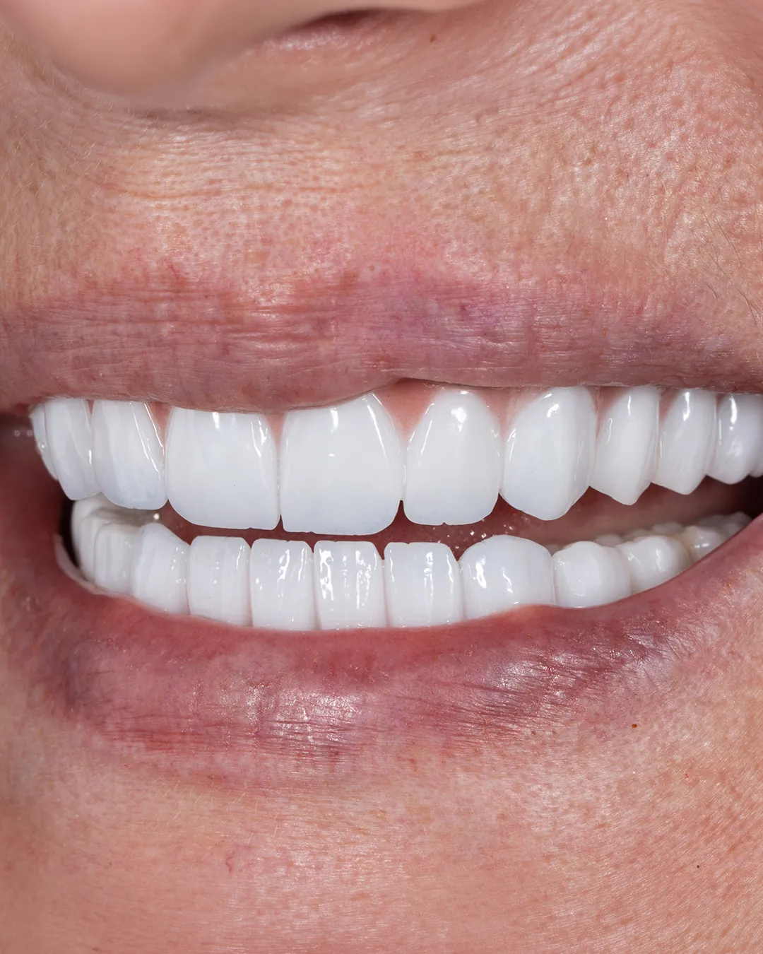 All on 4 Dental Implants